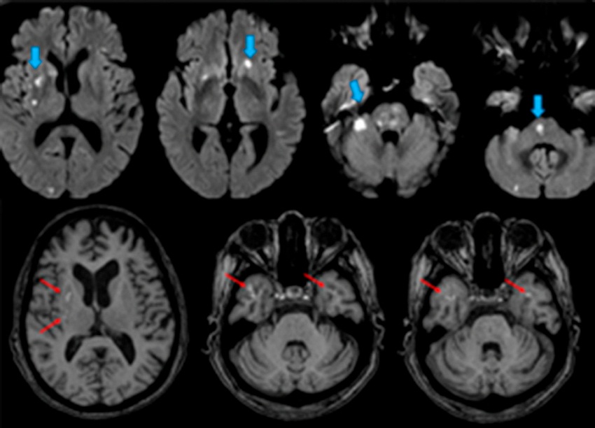 Resonancia magn&eacute;tica de enc&eacute;falo. A. m&uacute;ltiples cambios de se&ntilde;al en protuberancia, hemisferio cerebeloso derecho y sustancia blanca subcortical bihemisf&eacute;rica; B. im&aacute;genes hiperintensas en T1 en putamen, globo p&aacute;lido derecho y l&oacute;bulo temporal bilateral compatibles con sangrado subagudo.