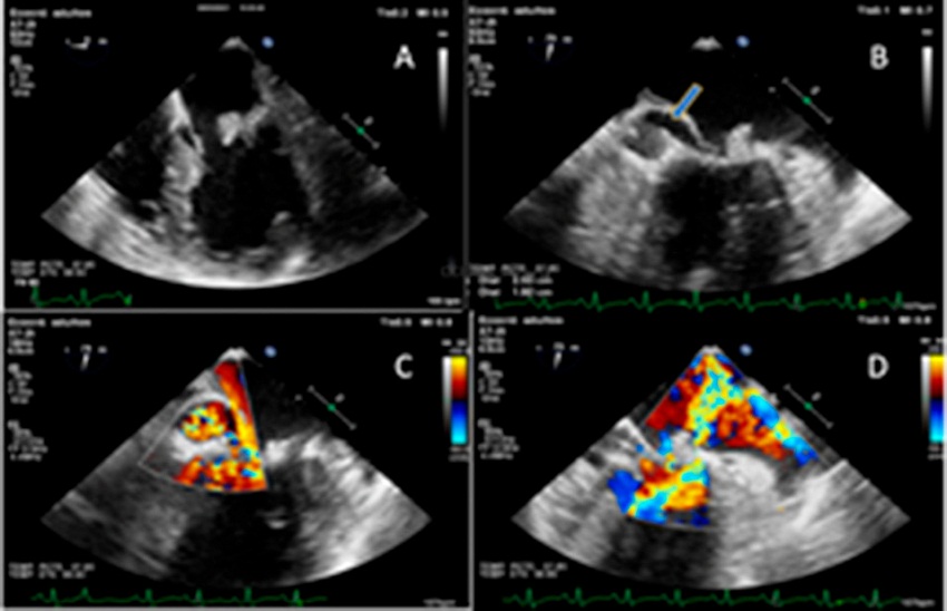 Ecocardiograma transtor&aacute;cico. A. engrosamiento valvular e im&aacute;genes m&oacute;viles en ambas valvas; B. pseudoaneurisma de la valva posterior mitral, di&aacute;metros 2,53 cm &times; 1,92 cm (flecha azul); C. flujo turbulento an&oacute;malo en el interior del pseudoaneurisma; D. insuficiencia mitral moderada.