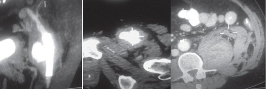 Angiotomografia: ruptura contenida de pseudoaneurisma de arteria femoral com&uacute;n a nivel del sitio de implantaci&oacute;n del stent previo con hematoma retroperitoneal homolateral