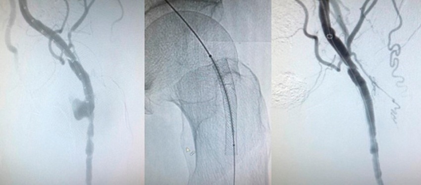 Exclusi&oacute;n endovascular de la ruptura arterial con un stent recubierto Viabahn, por dentro del wallstent indemne y permeable