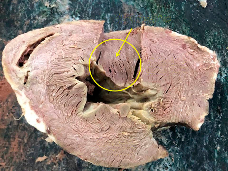 Fibras apexianas. Nótese el giro de las fibras al acercarse a la punta del ventrículo izquierdo.