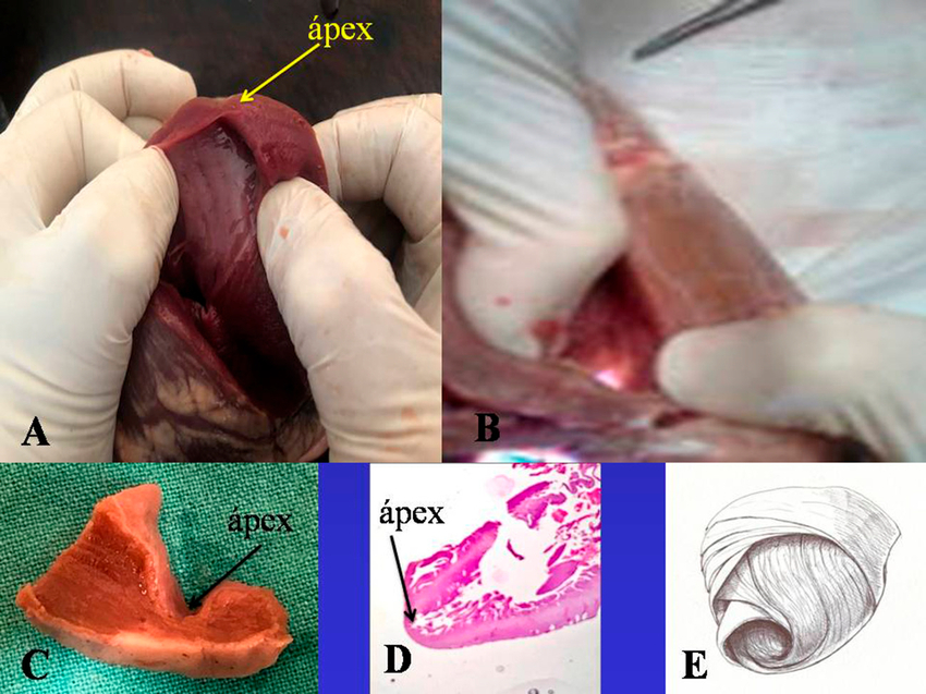 A: se observa el ápex cardíaco. B: La transiluminación positiva en el fondo de saco apexiano demuestra que prácticamente no hay fibras musculares en esta región. C y D: Detalle macro y microscópico del ápex que muestra el endocardio adosado al epicardio, casi sin capa muscular, la cual presenta un espesor del 10% en relación al miocardio contiguo. E: El dibujo del miocardio continuo plegado en hélix revela la naturaleza del ápex, el que queda conformado por una zona frágil dado el cambio de orientación del segmento descendente transformándose en ascendente. A y B: corazón de bovino. C: corazón humano adulto. D: embrión humano de 16 semanas.