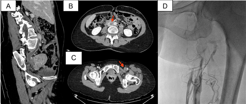 A: Corte parasagital de tomograf&iacute;a computada de abdomen que evidencia trombosis desde la vena cava inferior hasta la vena il&iacute;aca. B-C: Cortes axiales de tomograf&iacute;a computada de abdomen que evidencian la trombosis venosa en el eje venoso izquierdo (las flechas rojas indican las zonas de trombosis). D: Flebograf&iacute;a de miembro inferior izquierdo que confirma la oclusi&oacute;n vascular desde la vena femoral superficial en el segmento proximal hasta la vena cava inferior con circulaci&oacute;n colateral de gran desarrollo y defecto de relleno endoluminal compatible con trombo reciente.