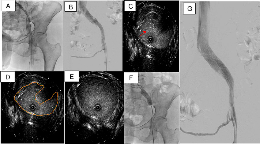 A: Imagen angiogr&aacute;fica post infusi&oacute;n de trombol&iacute;tico con cat&eacute;ter Zelante DVT&trade; mediante sistema Power Pulse. B: Imagen angiogr&aacute;fica post tromboaspiraci&oacute;n isovolum&eacute;trica activa con sistema AngioJet&trade; durante 130 segundos que objetiva ostensible mejor&iacute;a del flujo vascular y disminuci&oacute;n significativa de la carga tromb&oacute;tica, sin evidencia de improntas o defecto de relleno en el ostium de la vena il&iacute;aca izquierda. C: Ultrasonido intravascular que evidencia la zona de disminuci&oacute;n del calibre de la luz con la flecha roja. D: Ultrasonido intravascular que evidencia la zona de disminuci&oacute;n del calibre de la luz d&oacute;nde se marc&oacute; el contorno del vaso. E: Ultrasonido intravuscular que muestra el calibre normal de la vena sin compresi&oacute;n. F: Imagen angiogr&aacute;fica que muestra el bal&oacute;n de 15 &times; 40 mm insuflado en vena il&iacute;aca; se observa &ldquo;waist&rdquo; que muestra la zona de compresi&oacute;n evidenciada por el ultrasonido intravascular. G: Imagen angiogr&aacute;fica que muestra el resultado final post implante de stent autoexpandible Abre&trade; de 20 &times; 100 mm