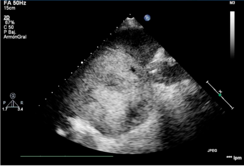 Imagen tumoral a nivel hep&aacute;tico