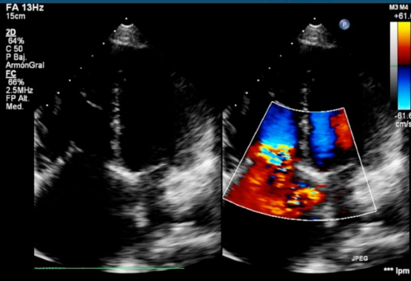 Insuficiencia tricusp&iacute;dea grave con apertura valvular fija.
