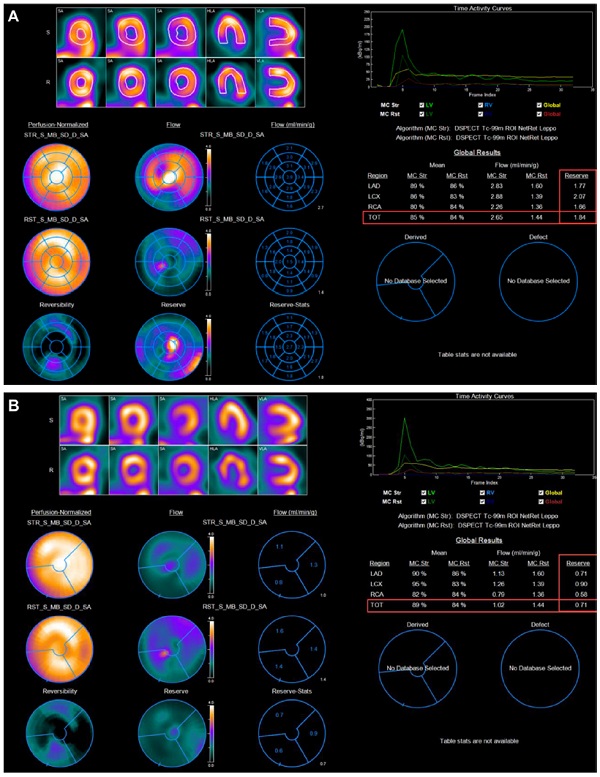 Paciente con DMV m&uacute;sculo liso y endotelio dependiente. A. Dipiridamol (RFM: 1,84) B. Prueba de fr&iacute;o (ΔFSM: 0,71)