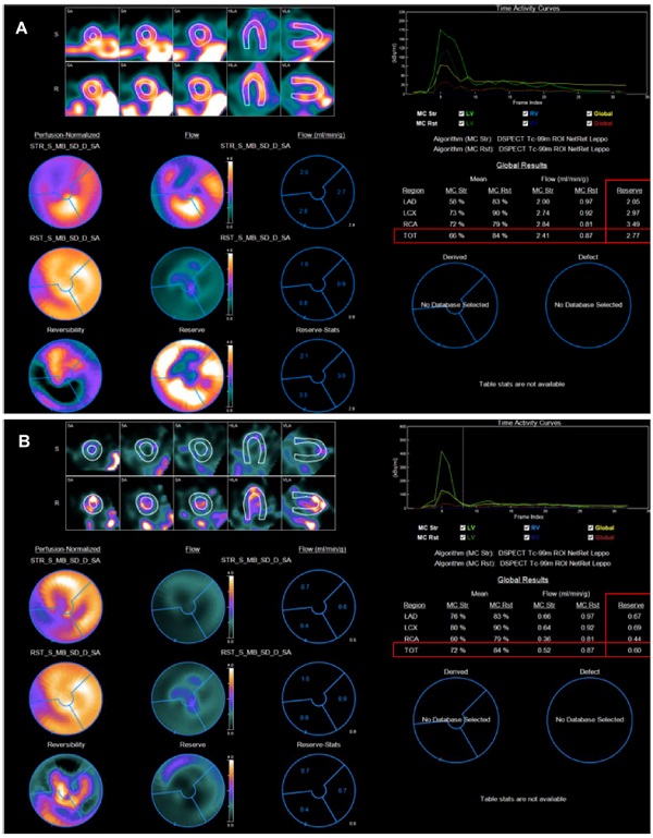 Paciente con vasoespasmo microvascular endotelio dependiente. A. Dipiridamol (RFM: 2,77) B. Prueba de fr&iacute;o (ΔFSM: 0,60)