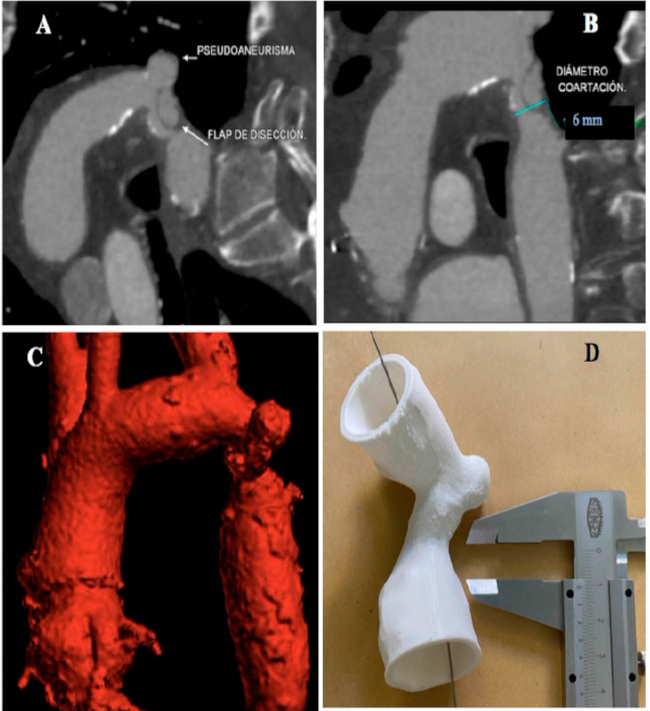 A-B: Corte sagital de angiotomografia que evidencia pseudoaneurisma, flap de disecci&oacute;n y di&aacute;metro de coartaci&oacute;n a&oacute;rtica. C-D: Reconstrucci&oacute;n 3D de coartaci&oacute;n de aorta asociado a pseudoaneurisma.