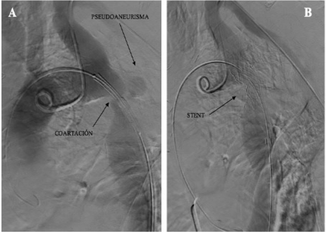 Angiograf&iacute;a digital incidencia sagital. A: Previo a apertura del stent. B: Posterior a apertura de stent.