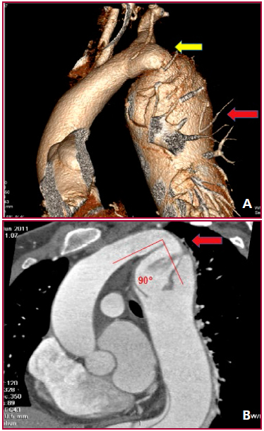 A. Reconstrucci&oacute;n 3D de angio.TC preoperatoria (Etapa 1): Se observa la recoartaci&oacute;n a&oacute;rtica (flecha amarilla) y aneurisma disecante de aorta descendente (52 mm) (flecha roja). B. Angio TC preoperatoria (Etapa 1): Se observa recoartaci&oacute;n a&oacute;rtica con angulaci&oacute;n de 90&deg; en arco a&oacute;rtico distal e hipoplasia postcoartaci&oacute;n. (flecha roja).