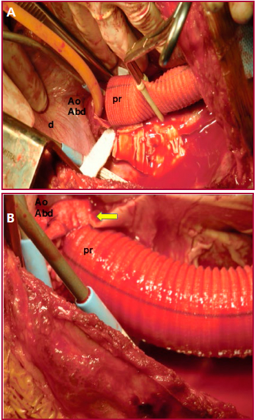 A. Imagen operatoria (Etapa 1): Anastomosis distal prot&eacute;sico (pr)- a&oacute;rtica a nivel del diafragma (d). Se observa el clamp transferido distalmente y la introducci&oacute;n de una sonda Foley en la aorta abdominal (Ao abd), para la confecci&oacute;n de la anastomosis distal. B. Imagen operatoria (Etapa 1): Anastomosis distal, entre la pr&oacute;tesis (pr) de Dacron y la aorta abdominal (Ao Abd) realizada en forma abierta finalizada (flecha amarilla).