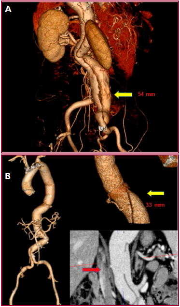 A. Reconstrucci&oacute;n 3D preoperatoria de angio-TC (Etapa 2): Se observa el flap de disecci&oacute;n y el aneurisma de aorta abdominal infrarrenal (54 mm) e il&iacute;aca derecha (flecha amarilla). B. Reconstrucci&oacute;n 3D de angio-TC posoperatoria (Etapa 2): Se observa el resultado final, con aorta descendente (33 mm( (flecha amarilla) y flap de disecci&oacute;n del segmento de aorta abdominal residual, con permeabilidad visceral conservada (flecha roja).