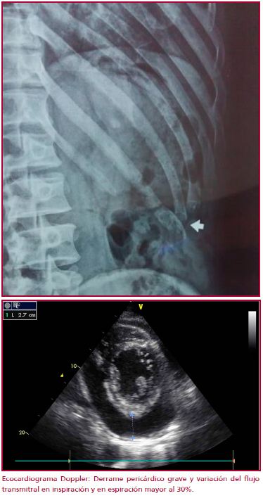 ECG: Ritmo sinusal, 75 latidos por minuto, Eje 100 grados. BCRD. Trastornos difusos de la repolarizaci&oacute;n en cara anterior.