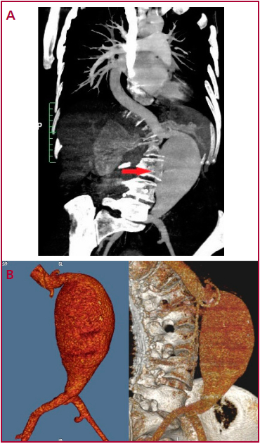A. y B. Angiotomograf&iacute;a con aneurisma de aorta abdominal infrarrenal de 77 mm sin trombo mural y arterias il&iacute;acas de calibre conservado