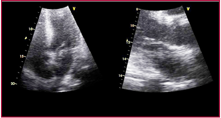 Ecocardiograma Doppler con imagen compatible con trombo en tránsito