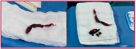 Imágenes correspondientes a trombo en tránsito (izquierda) y trombectomia pulmonar (Der.)