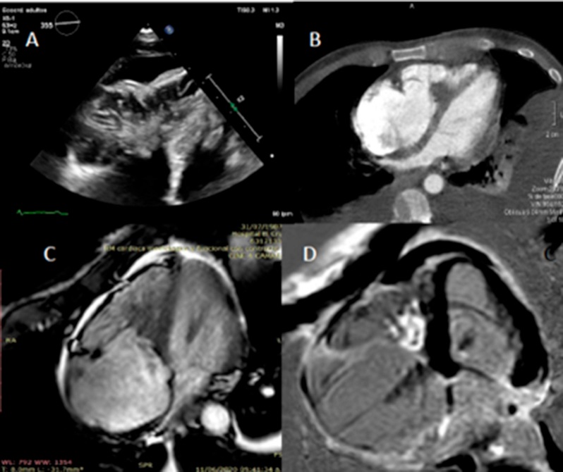 De izquierda a derecha y de arriba abajo. A. Ecocardiografía transtorácica bidimensional con foco en el ventrículo derecho (VD). Muestra masa heterogénea medioventricular derecha, con compromiso del aparato subvalvular tricuspídeo, retracción de valva septal de la tricúspide, retracción focal en pared anterior del VD y derrame pericárdico anterior. B. Tomografía Cardíaca con contraste. Muestra hipocaptación de la masa ocupante en el VD con base de implante en el septum interventricular. C. Resonancia Cardíaca. Masa intraventricular en VD que compromete el aparato subvalvular tricuspídeo, banda moderadora (que provoca retracción de pared libre del VD) y valva septal de la válvula tricúspide. D. Misma imagen con realce tardío positivo en la masa intraventricular derecha y realce tardío negativo en el ventrículo izquierdo.