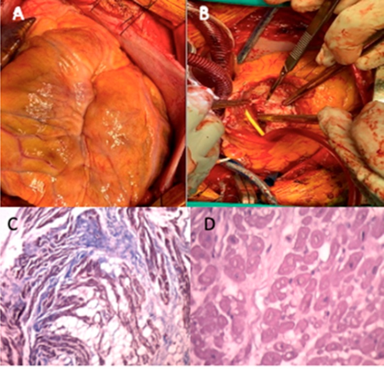 Arriba: de derecha a izquierda fotos quirúrgicas. A. Se visualiza retracción de la pared del VD. B. Incisión anterior en donde se visualiza compromiso del aparato subvalvular tricuspídeo . Abajo: de izquierda a derecha Anatomía patológica. C. Técnica con tricrómico que muestra fibrosis intersticial en violeta (flecha) y abundantes adipocitos en blanco (flecha). D. Tinción con hematoxilina-eosina en la que se observa hipertrofia y vacuolización de los miocitos maduros.