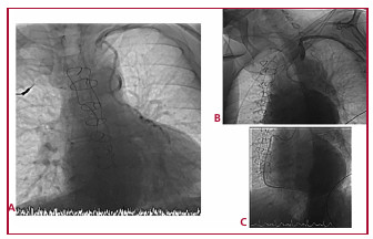 Cateterismo preferente: Oclusión del origen de la subclavia izquierda (A y B); se objetiva un cese brusco del paso de contraste desde la subclavia a la aorta, tras su administración vía radial izquierda. Se aprecian los puentes de arteria mamaria interna izquierda a descendente anterior, mamaria derecha a obtusa marginal (A, B), y safena a interventricular posterior (C), permeables. Lechos distales sin lesiones. 
