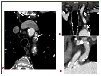 TAC de troncos supraaórtico y polígono de Willis: imágenes axial (A), coronal (B) y sagital (C), que muestran una ateromatosis calcificada con oclusión en origen de arteria subclavia izquierda. La arteria mamaria interna izquierda está permeable. No se aprecian oclusiones en estructuras de polígono de Willis y sistema vertebrobasilar ni carotídeo. 
