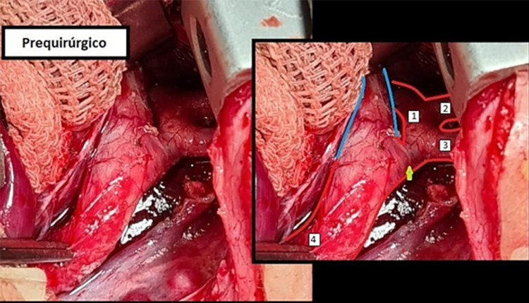 Se observa el arco transverso (1), car&oacute;tida izquierda (2), subclavia izquierda (3), aorta descendente (4), ductus arterioso persistente (l&iacute;neas celestes) y flecha verde indicando istmo a&oacute;rtico y zona de coartaci&oacute;n. El tronco braquiocef&aacute;lico arterioso no se observa en esta imagen