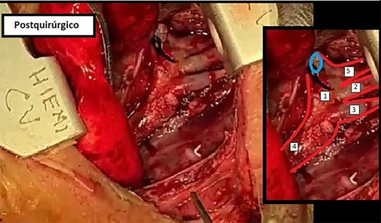 En la imagen postquir&uacute;rgica se puede observar el ductus arterioso ligado y seccionado (c&iacute;rculo celeste), la zona del istmo a&oacute;rtico y coartaci&oacute;n resecada y la zona de anastomosis t&eacute;rmino terminal ampliada; tronco braquiocef&aacute;lico arterial (5)