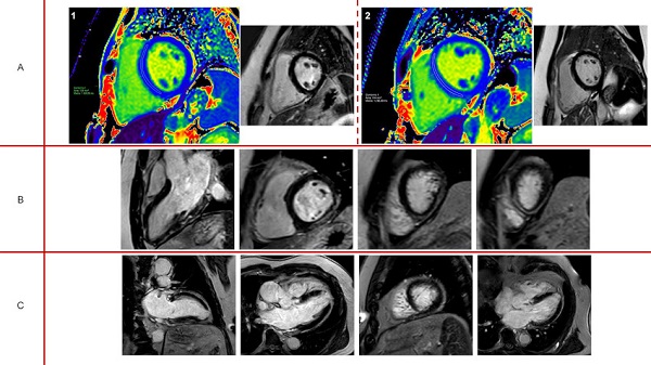 Ejemplos de hallazgos en la Resonancia Magn&eacute;tica Card&iacute;aca 