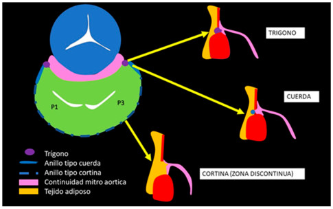 Disposici&oacute;n del anillo mitral, zonas fibrosas en la cercan&iacute;a de los trigonos, en el resto del anillo zonas discontinuas con infiltraci&oacute;n grasa pudiendo haber disyunci&oacute;n (modificado de European Heart Journal - Cardiovascular Imaging, Volume 22, Issue 6, June 2021, Pages 623-625)