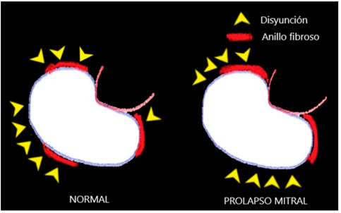 Del estudio anatomopatol&oacute;gico de la Dra. Angelini , ejemplos de extensi&oacute;n de anillo fibroso y de zonas de disyunci&oacute;n en un caso normal y otro con prolapso , en todos los normales y pacientes con prolapso encontr&oacute; disyunci&oacute;n (modificado de Br Heart J 1988; 59: 712-6)