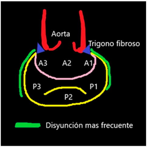 Del estudio de To H. y col, las zonas de mayor frecuencia de disyunci&oacute;n se encontraron en las zonas de los segmentos P1 y P3