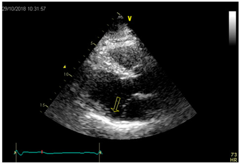 Imagen paraesternal de eje largo que muestra marcada separaci&oacute;n entre la valva posterior de la mitral y la uni&oacute;n auriculoventricular en un paciente con prolapso de la v&aacute;lvula mitral