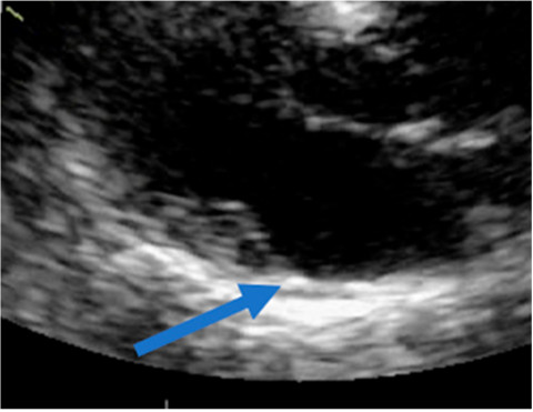 Imagen diast&oacute;lica del paciente de la figura 2 que demuestra que la inserci&oacute;n de la valva posterior es en la pared atrial demostrando la zona de la disyunci&oacute;n en di&aacute;stole