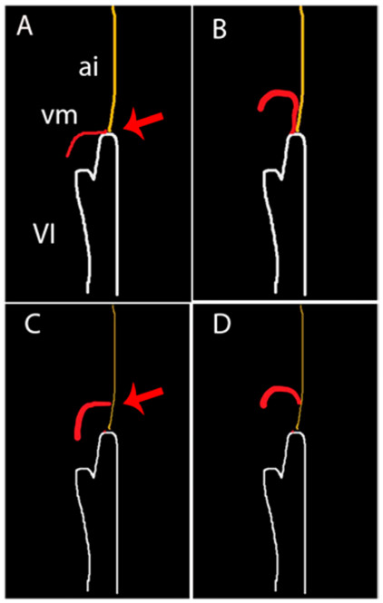 Las im&aacute;genes A y B corresponden a la descripci&oacute;n del fenotipo de seudodisyunci&oacute;n, donde la valva posterior, al prolapsar, se adosa a la pared posterior y crea la falsa imagen de disyunci&oacute;n, pero en di&aacute;stole (A) la inserci&oacute;n est&aacute; en la uni&oacute;n AV. Los esquemas C Y D corresponden al fenotipo de disyunci&oacute;n verdadera con la inserci&oacute;n diast&oacute;lica en la aur&iacute;cula izquierda, ai: aur&iacute;cula izquierda vm: v&aacute;lvula mitral, VI: ventr&iacute;culo izquierdo