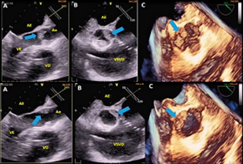 Superior. Ecocardiograma transesof&aacute;gico (ETE) 2D y 3D en di&aacute;stole. (A) Plano ortogonal, es&oacute;fago medio, eje longitudinal 141&deg;, engrosamiento de la v&aacute;lvula a&oacute;rtica (flecha). (B) Eje transversal 60&deg; v&iacute;a de salida y entrada del ventr&iacute;culo derecho con engrosamiento valvular (flecha). (C) Imagen tridimensional en tiempo real, vista quir&uacute;rgica con alteraciones morfol&oacute;gicas de la v&aacute;lvula a&oacute;rtica (flecha). Inferior. ETE 2D y 3D en s&iacute;stole. A, B y C con hallazgos similares. 