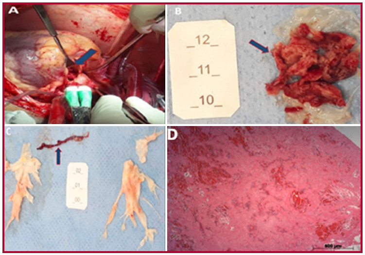 Imagen macrosc&oacute;pica. (A) Intraoperatorio de reemplazo valvular a&oacute;rtico (flecha). (B) Gran cantidad de material amorfo rojo oscuro, irregular, adherido a las v&aacute;lvulas semilunares. (C) Trombo posterior a la tromboendarterectom&iacute;a de la arteria pulmonar. (D) Examen histol&oacute;gico del material amorfo rojo oscuro adherido a la v&aacute;lvula: trombo de fibrina con &aacute;reas de hemorragia. Coloraci&oacute;n por hematoxilina-eosina.