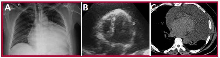 Resonancia magn&eacute;tica card&iacute;aca: A: se evidencia derrame peric&aacute;rdico leve a moderado. B: Desplazamiento septal hacia el ventr&iacute;culo en inspiraci&oacute;n forzada. C: Realce tard&iacute;o a nivel del pericardio.