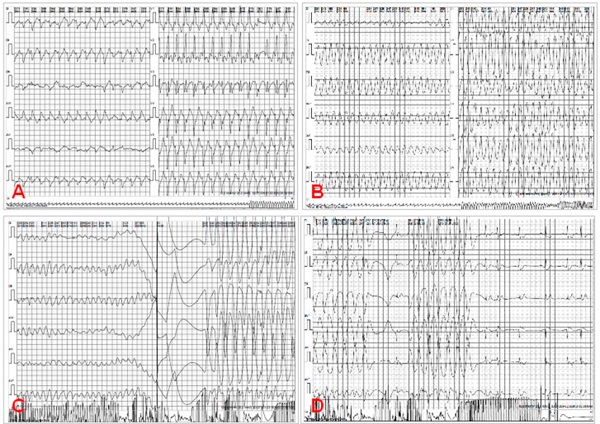 Secuencia electrocardiogr&aacute;fica del evento A: Taquicardia de QRS ancho (167 lpm), con morfolog&iacute;a de rama derecha, eje superior y signos que alertan origen ventricular (disociaci&oacute;n AV y latido de fusi&oacute;n). B: Progresi&oacute;n a Taquicardia ventricular polimorfa tipo Torsade de Pointes. C: Descarga con desfibrilador. D: Salida a Ritmo sinusal.
