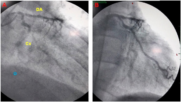 Coronariograf&iacute;a. A: Inyecci&oacute;n de contraste en el tronco de la coronaria izquierda, donde se observa oclusi&oacute;n de la arteria Descendente Anterior y lesiones significativas en la Circunfleja. B: Inyecci&oacute;n de contraste posterior a angioplastia con stents en arteria Circunfleja con restablecimiento del flujo.