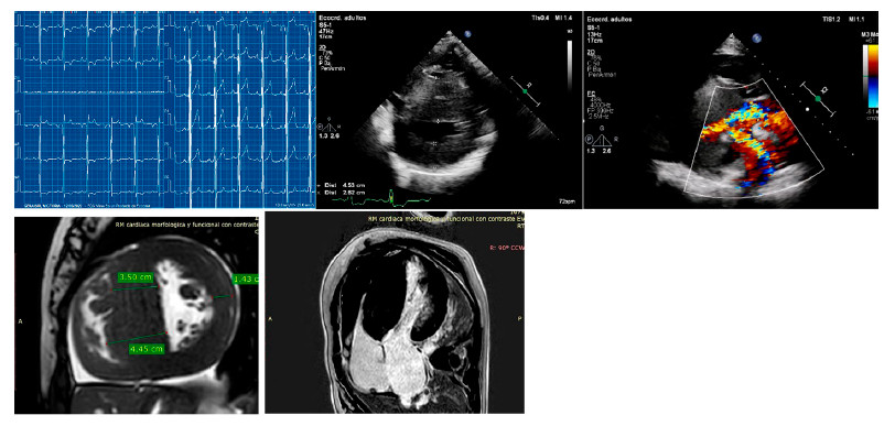 Adolescente de 17 a&ntilde;os con angor de esfuerzo (F+ y G-) con VUS+