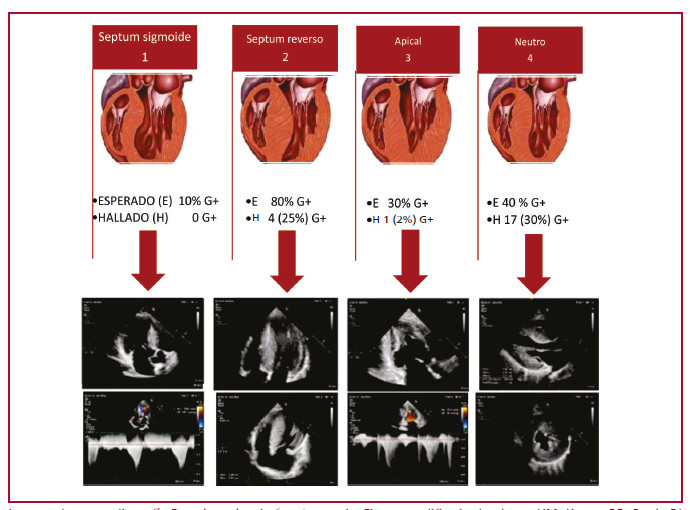 Patrones de hipertrofia seg&uacute;n la clasificaci&oacute;n de Lever et al. Probabilidad pretest de estudio gen&eacute;tico positivo seg&uacute;n subtipo anat&oacute;mico