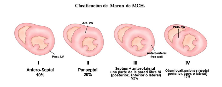 Maron et al 9 establecieron una clasificaci&oacute;n morfol&oacute;gica de cuatro tipos: tipo I, hipertrofia septal-anterior; tipo II, hipertrofia septal-anterior y septal-posterior; tipo III, hipertrofia septal y antero-lateral, y tipo IV, hipertrofia septal-posterior y/o antero-lateral. 