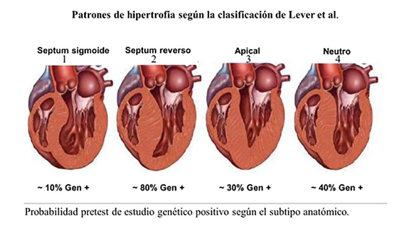 Modificado de: Maron BJ. Hypertrophic cardiomyopathy. Curr Probl Cardiol. 1993 Nov;18(11):639-704. doi: 10.1016/01462806(93)90025-w. PMID: 7903919.