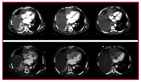 Tomograf&iacute;a computarizada (TC). Arriba: TC no sincronizada, con una lesi&oacute;n hipodensa localizada sobre las cavidades cardiacas derechas y un derrame pleural derecho grave con atelectasias asociadas. Abajo: TC sincronizada, con una masa pre-cardiaca derecha de 8,5 &times; 10 cm, que realza tras la administraci&oacute;n de contraste. La masa ejerce efecto masa y posiblemente infiltra la aur&iacute;cula derecha, se encuentra en contacto con dudosa infiltraci&oacute;n del ventr&iacute;culo derecho y contacta con la pared tor&aacute;cica anterior. 