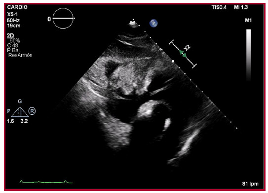 Ecocardiograma transtor&aacute;cico, acceso subcostal. Masa de aspecto s&oacute;lido y heterog&eacute;neo en el saco peric&aacute;rdico anterior que comprime el surco auriculoventricular y parece que se adhiere a la pared ventricular.