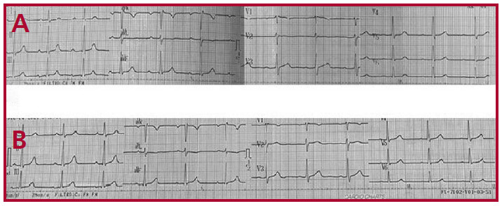 A. ECG: PR prolongado (270 msg). B. ECG: PR normal (200 msg)