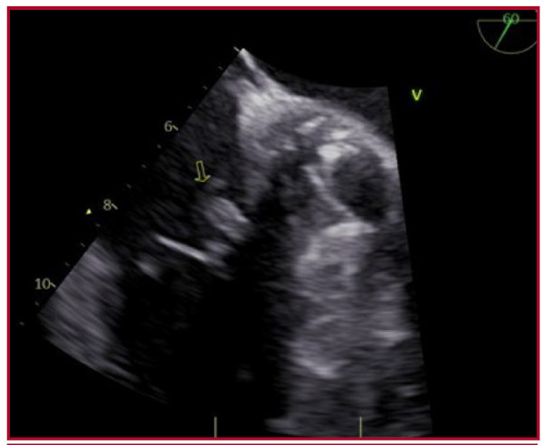 ETE: Vista 60&deg; se observa vegetaci&oacute;n en valva septal tricuspidea