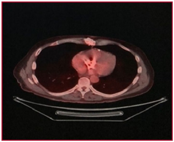 PET/TC con fl&uacute;or-18- desoxiglucosa: proyecci&oacute;n transversa. Se aprecia captaci&oacute;n difusa en la pr&oacute;tesis a&oacute;rtica