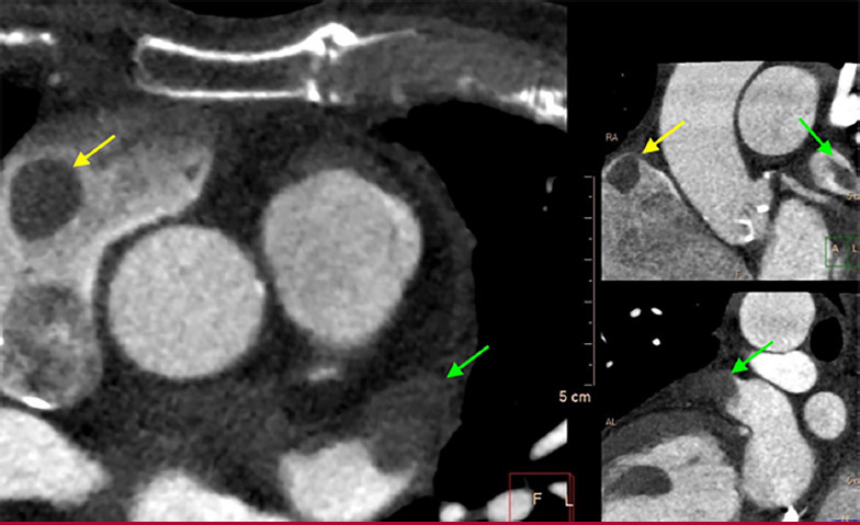Fase precoz de contraste. Defectos de relleno compatibles con masas en techo de aur&iacute;cula derecha (flecha amarilla) y cuerpo distal de la orejuela izquierda (flecha verde)