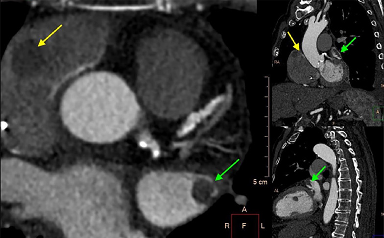 Fase tard&iacute;a de contraste. Persistencia del defecto en ambas aur&iacute;culas.